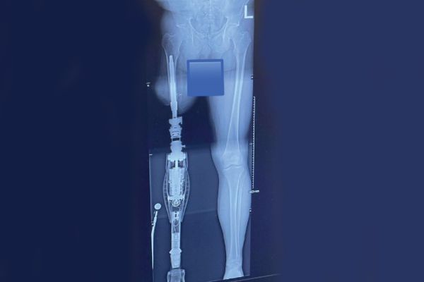 x-ray of above-knee osseo-integrated implant with prosthetic leg